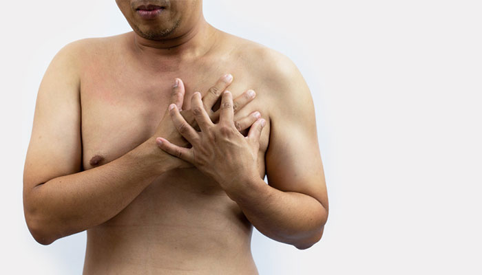 Gynecomastia is defined as an overdevelopment of breast tissues in male individuals. Typically, it is characterized by large breasts that grow unevenly